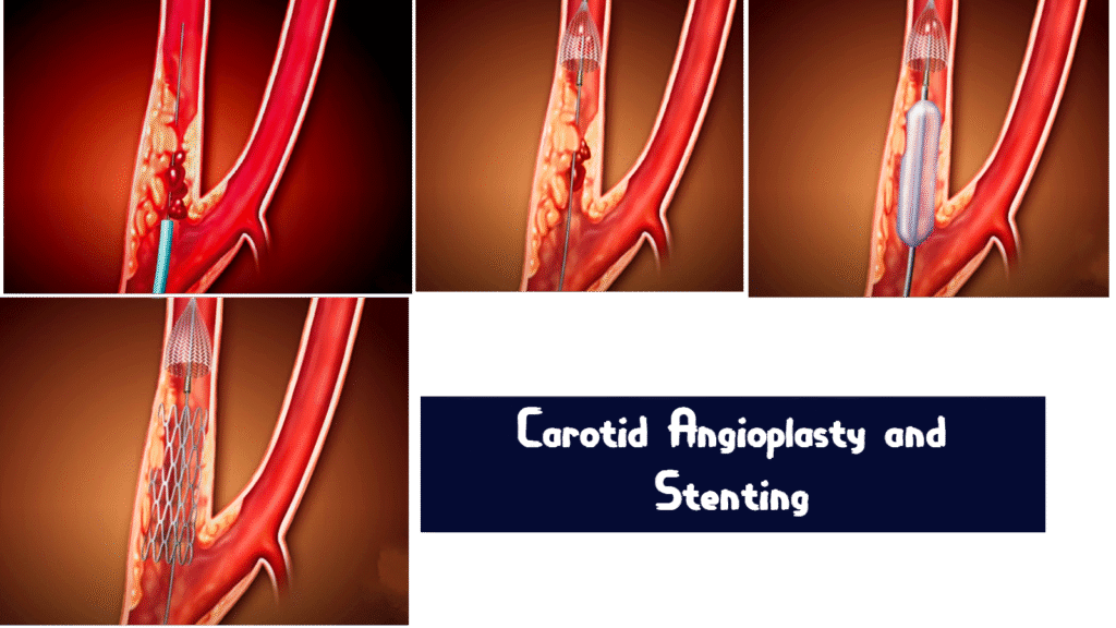 Carotid Angioplasty and Stenting