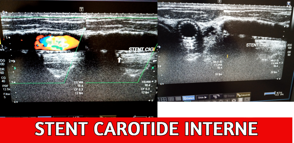 Un stent est un minuscule tube expansible qui maintient l'artère ouverte. Le pontage rétablit la circulation en court-circuitant l'artère bouchée à l'aide d'une artère saine provenant d'une autre partie du corps.